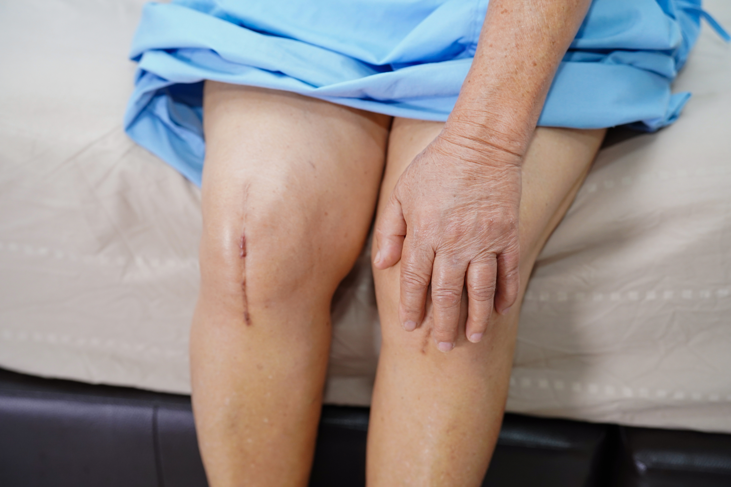You are currently viewing 3 Things to Know if You Want to Get Knee or Hip Replacement Surgery